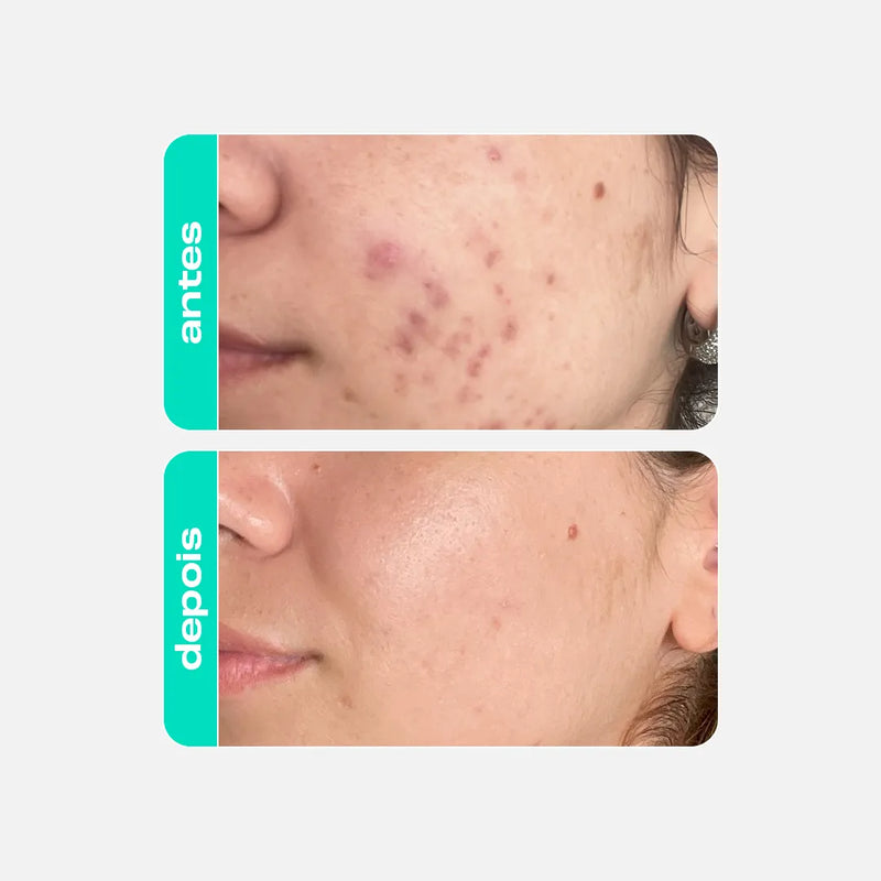 Gel-creme Retexturizador Antioleosidade - Glicointense Peel