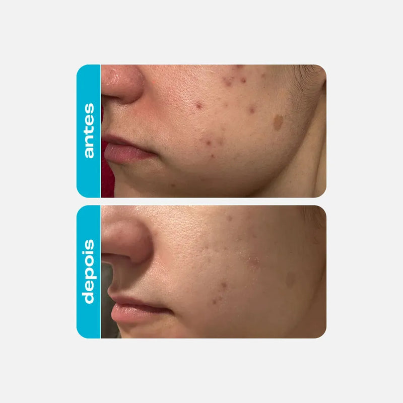 Ácido Glicólico – Creme Retexturizador